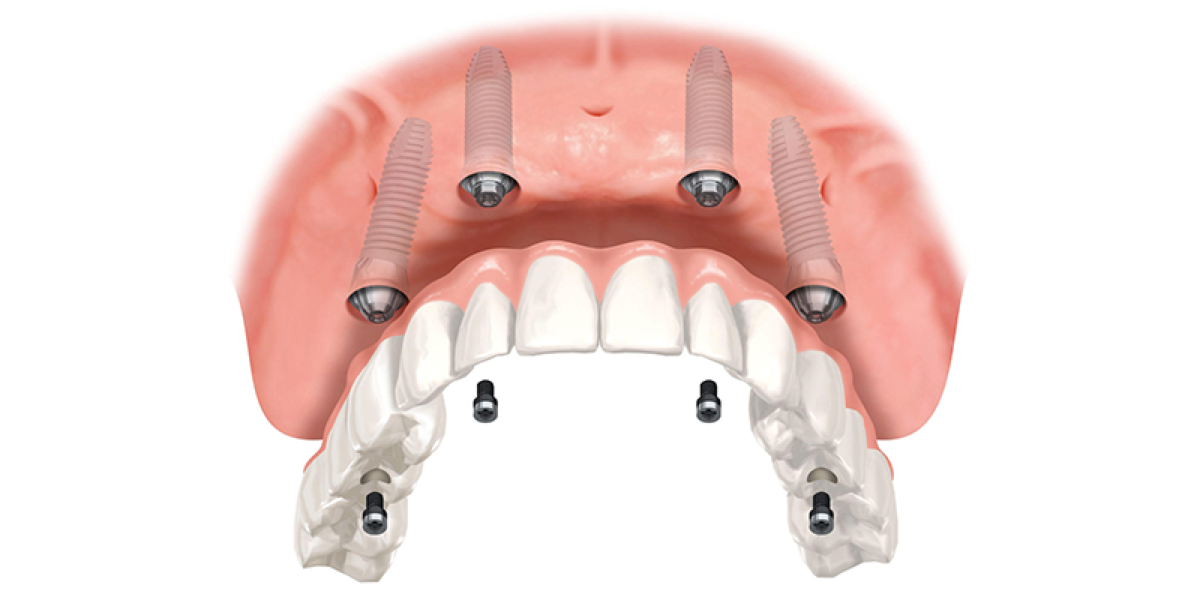 Wizualizacja implantów All-on-4 w żuchwie