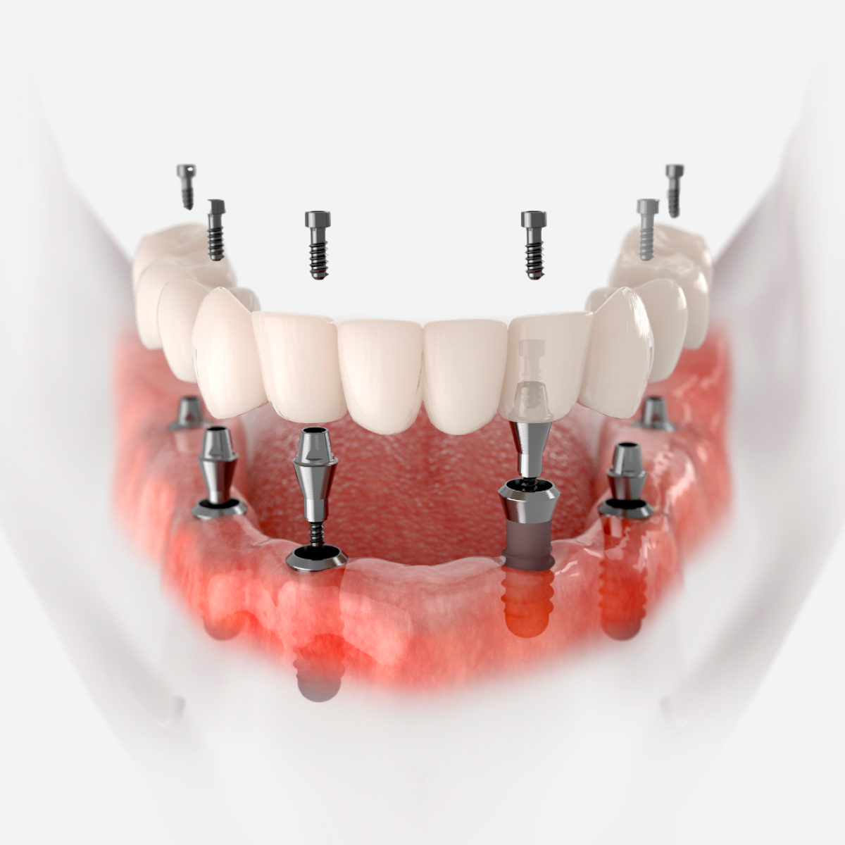 Wizualizacja implantów All-on-6