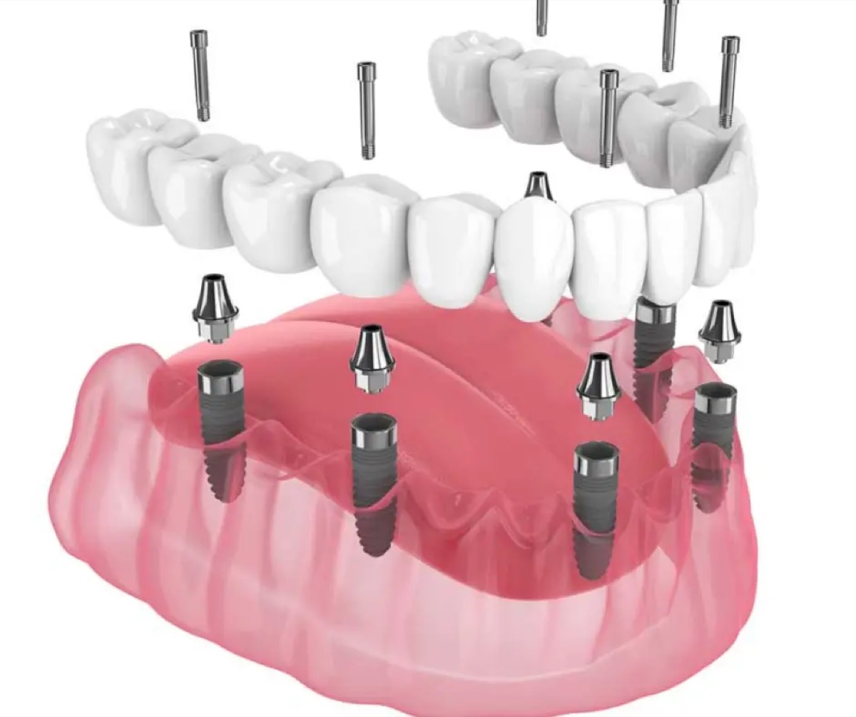 Diagram mostu protetycznego na implantach
