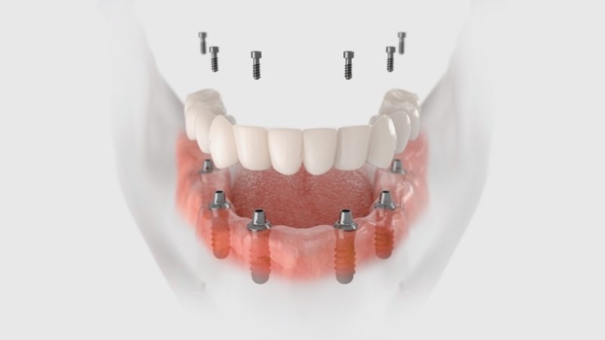 Model pełnego łuku zębowego na implantach